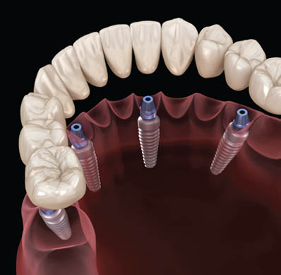 Dental Implants in Midland, TX