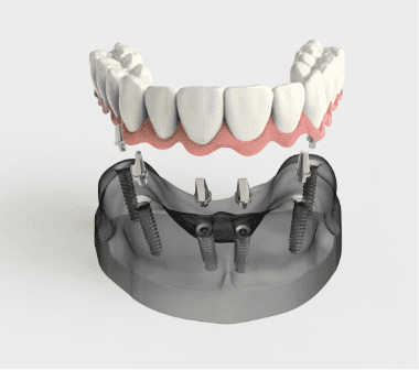 Dental Implants